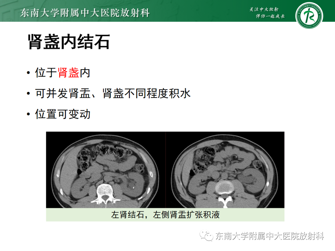 影像PPT - 【PPT】髓质海绵肾-24