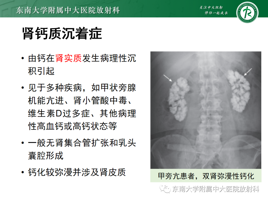 影像PPT - 【PPT】髓质海绵肾-25