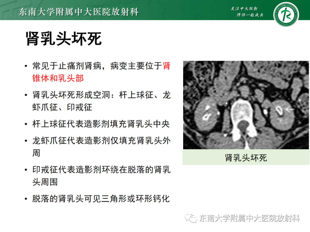 影像PPT - 【PPT】髓质海绵肾-26