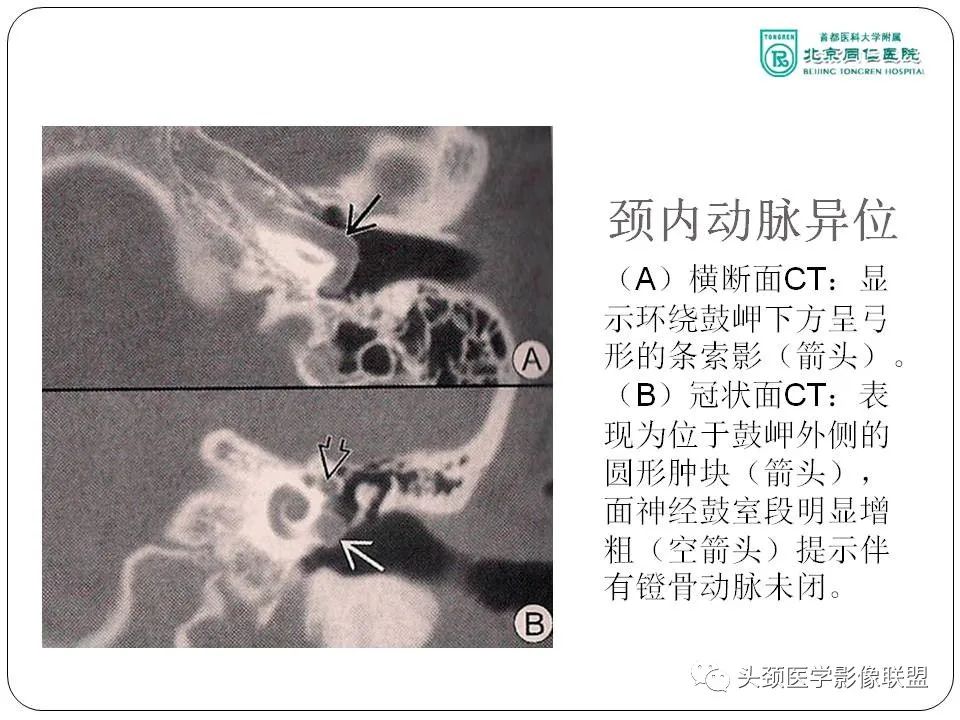 影像PPT - 【PPT】搏动性耳鸣诊疗进展-15