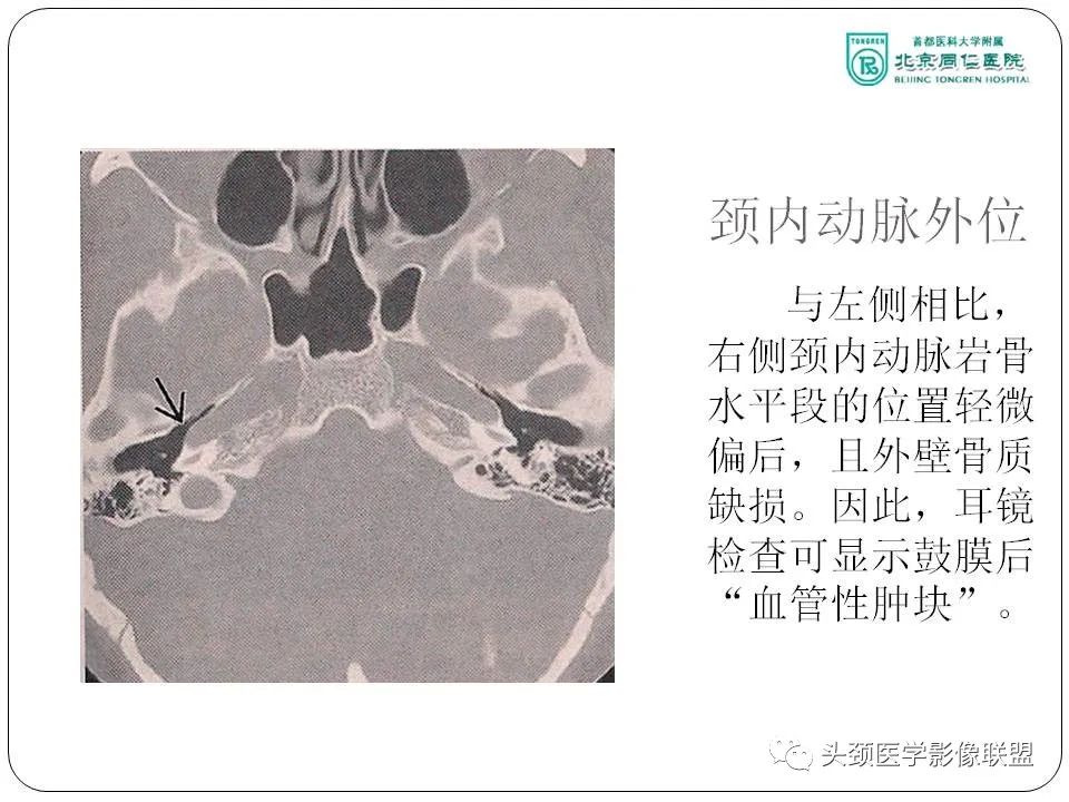 影像PPT - 【PPT】搏动性耳鸣诊疗进展-17