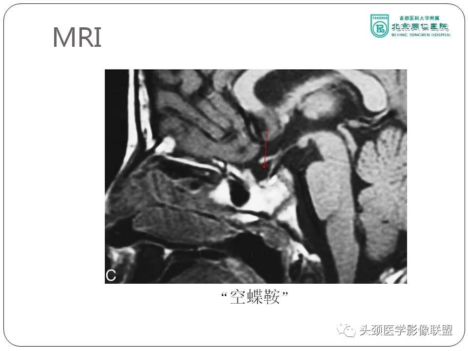 影像PPT - 【PPT】搏动性耳鸣诊疗进展-20