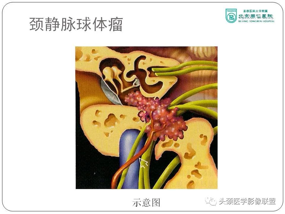 影像PPT - 【PPT】搏动性耳鸣诊疗进展-23