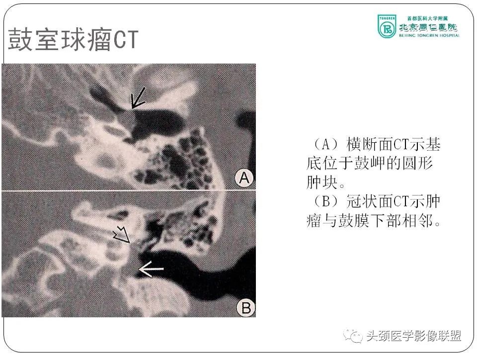 影像PPT - 【PPT】搏动性耳鸣诊疗进展-24