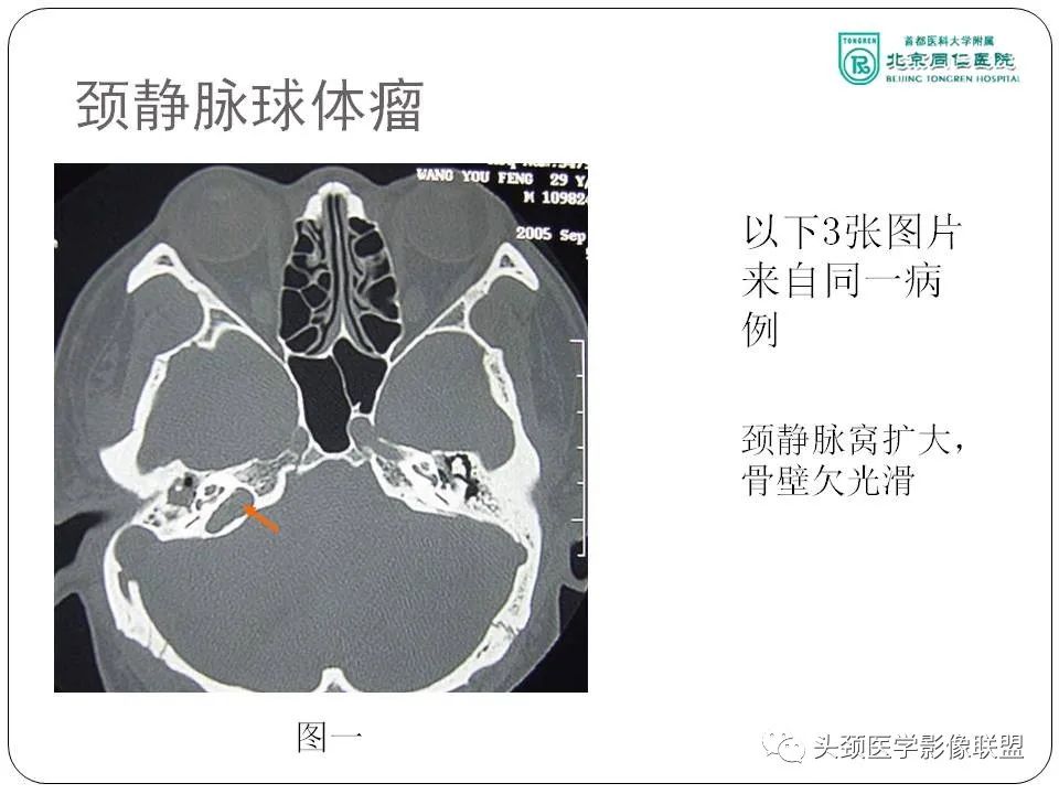 影像PPT - 【PPT】搏动性耳鸣诊疗进展-26