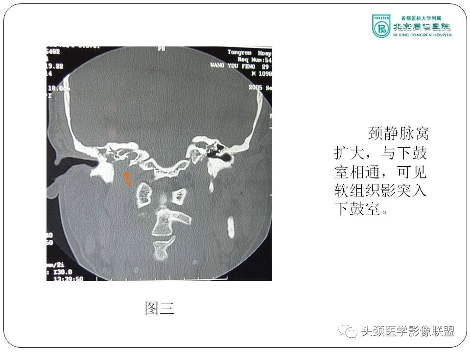 影像PPT - 【PPT】搏动性耳鸣诊疗进展-28