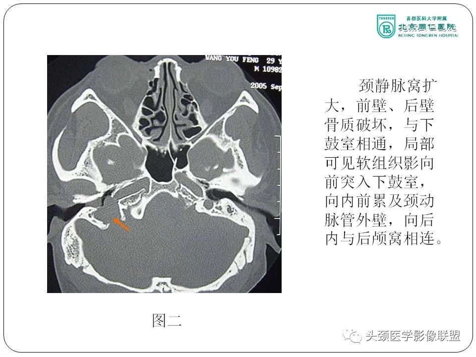 影像PPT - 【PPT】搏动性耳鸣诊疗进展-27
