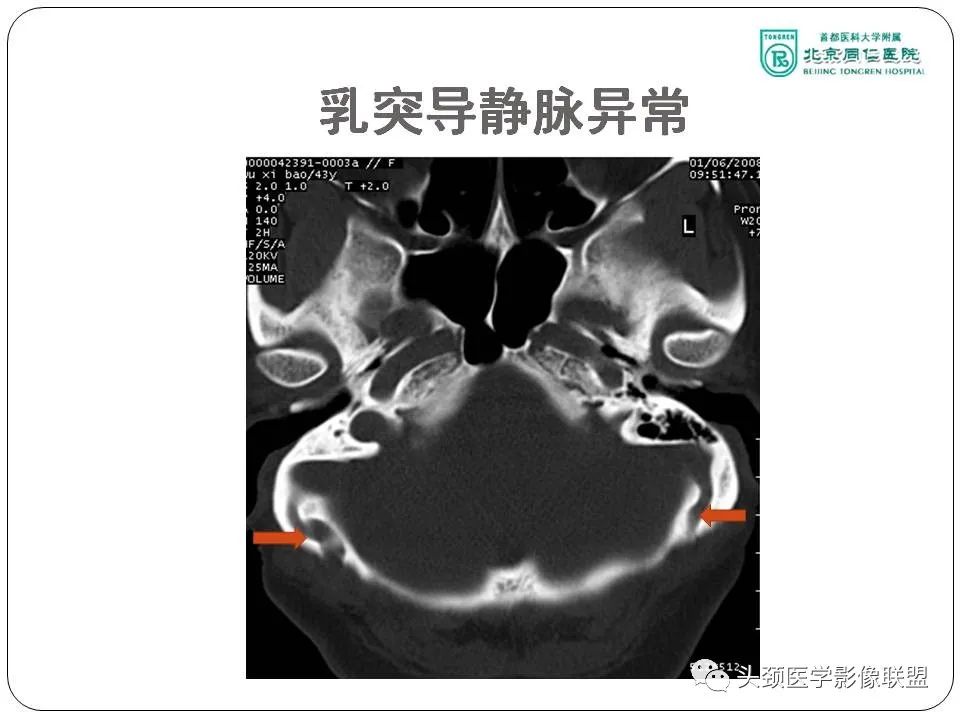 影像PPT - 【PPT】搏动性耳鸣诊疗进展-32