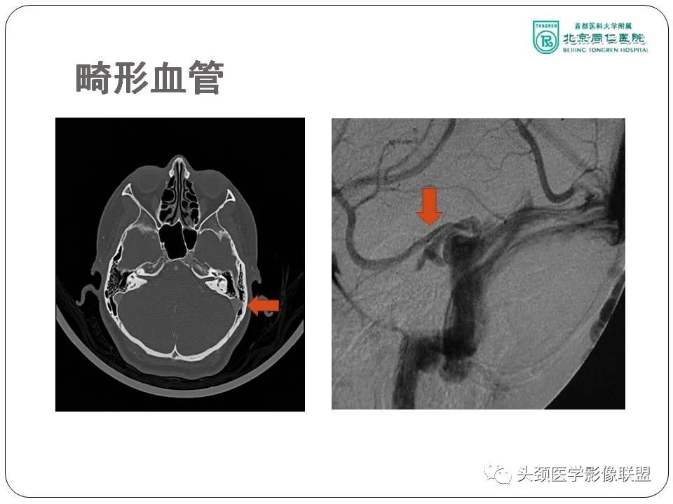 影像PPT - 【PPT】搏动性耳鸣诊疗进展-35