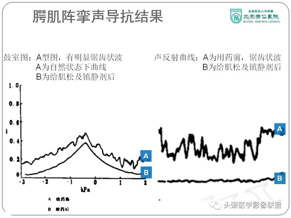 影像PPT - 【PPT】搏动性耳鸣诊疗进展-43