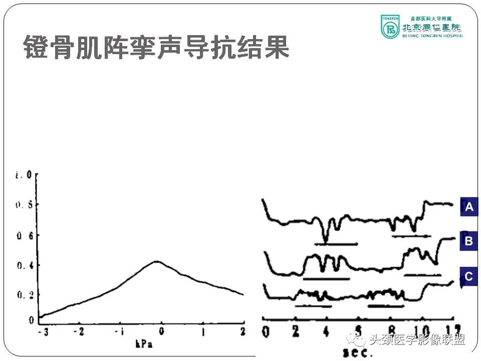 影像PPT - 【PPT】搏动性耳鸣诊疗进展-45