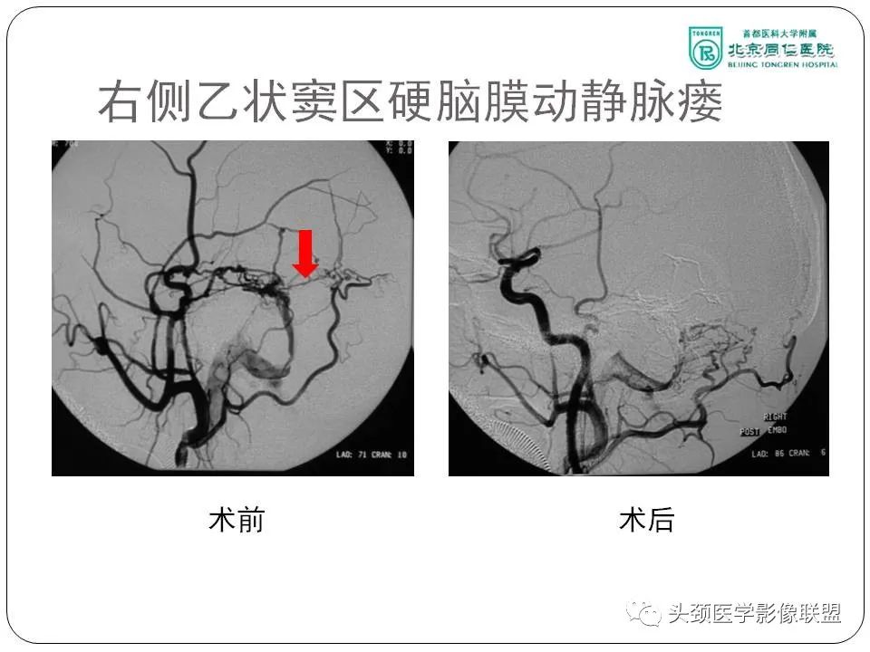 影像PPT - 【PPT】搏动性耳鸣诊疗进展-66