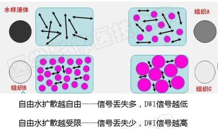 影像PPT - 【PPT】脑梗在磁共振弥散图像上信号的演变过程-7