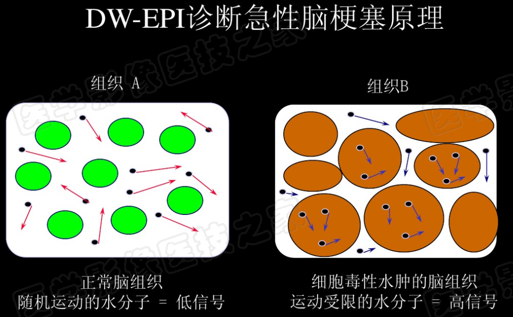 影像PPT - 【PPT】脑梗在磁共振弥散图像上信号的演变过程-9