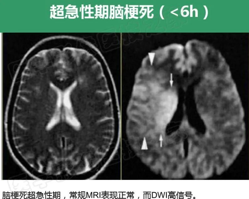 影像PPT - 【PPT】脑梗在磁共振弥散图像上信号的演变过程-14