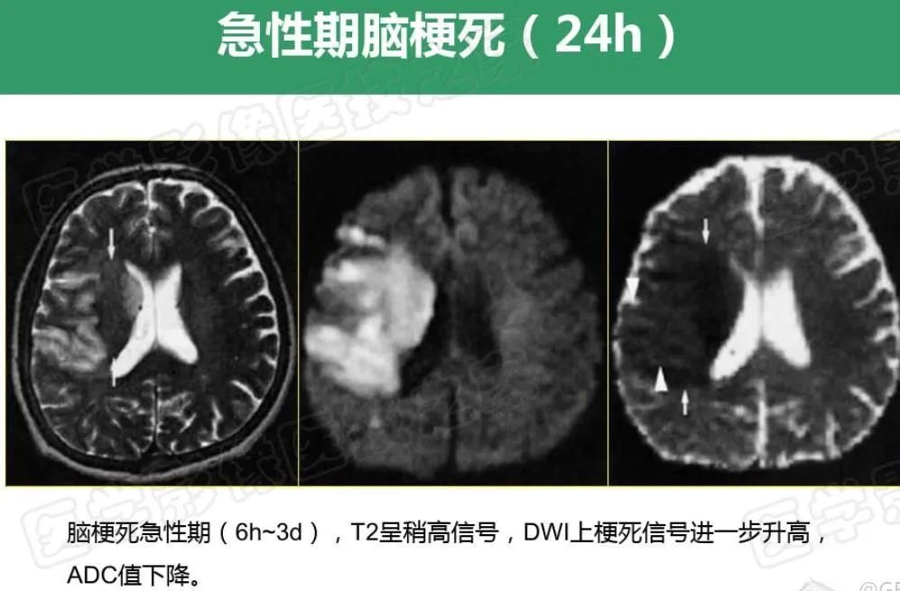 影像PPT - 【PPT】脑梗在磁共振弥散图像上信号的演变过程-15