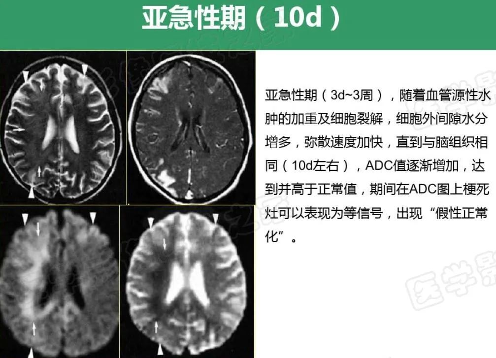 影像PPT - 【PPT】脑梗在磁共振弥散图像上信号的演变过程-16