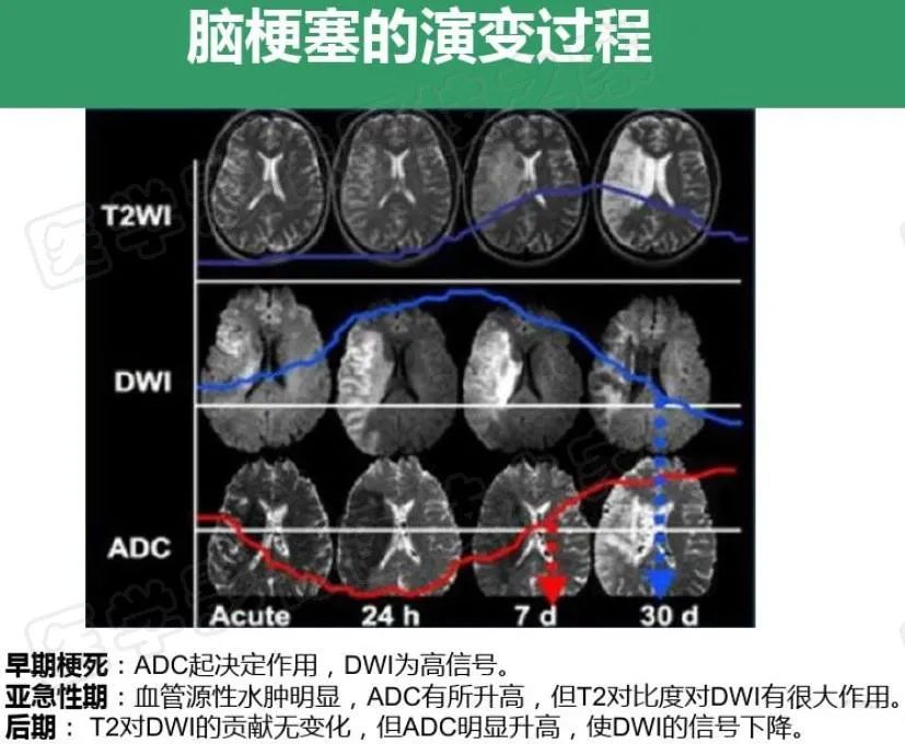影像PPT - 【PPT】脑梗在磁共振弥散图像上信号的演变过程-18