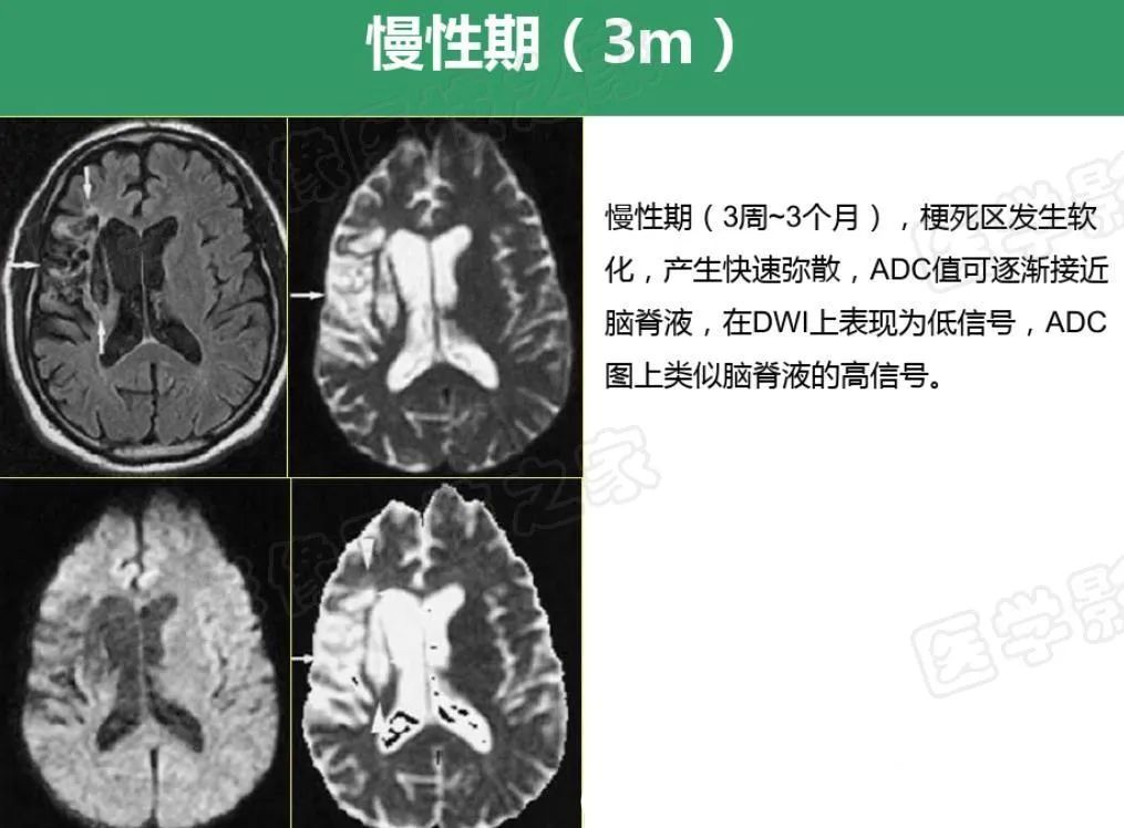 影像PPT - 【PPT】脑梗在磁共振弥散图像上信号的演变过程-17