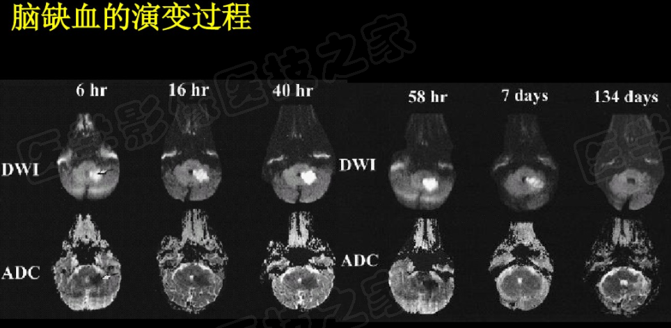 影像PPT - 【PPT】脑梗在磁共振弥散图像上信号的演变过程-22