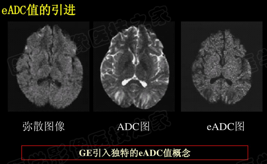 影像PPT - 【PPT】脑梗在磁共振弥散图像上信号的演变过程-25