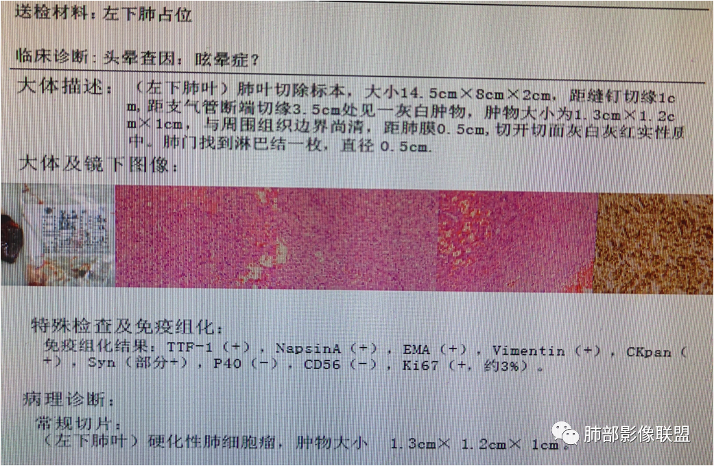 影像PPT - 【病例】肺部光滑结节—至关重要的影像鉴别点-32 影像PPT - 【病例】肺部光滑结节—至关重要的影像鉴别点-32