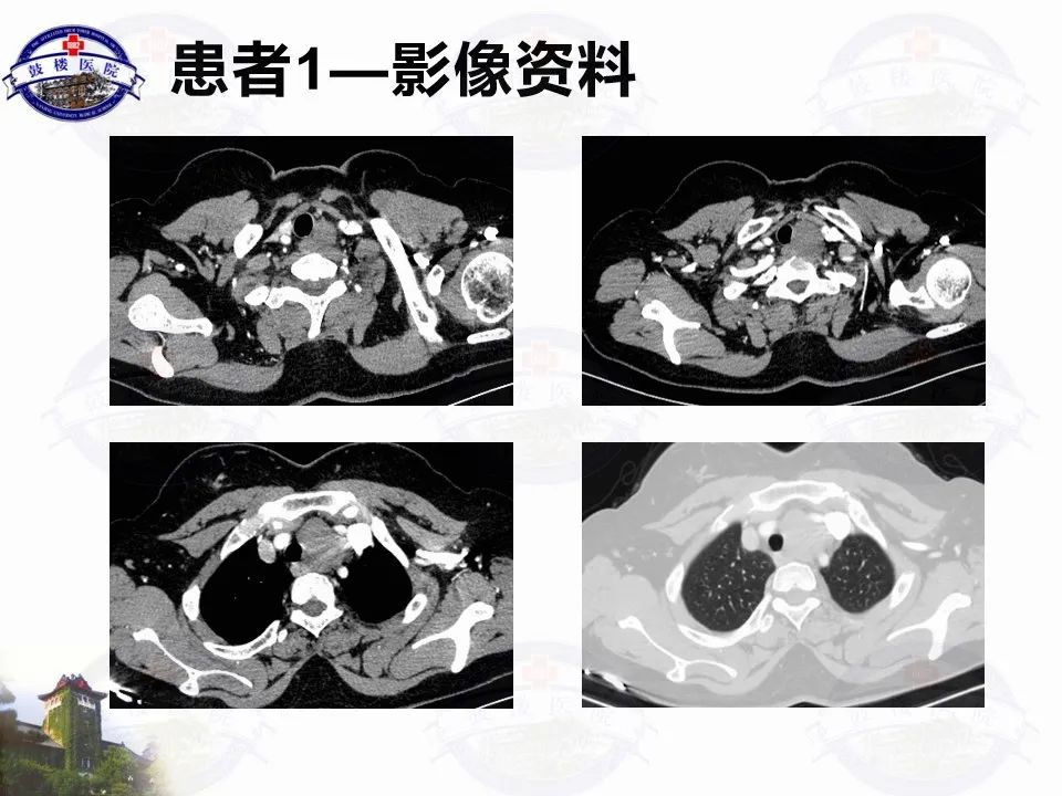 影像PPT - 【PPT】纵隔囊性病变CT诊断-3