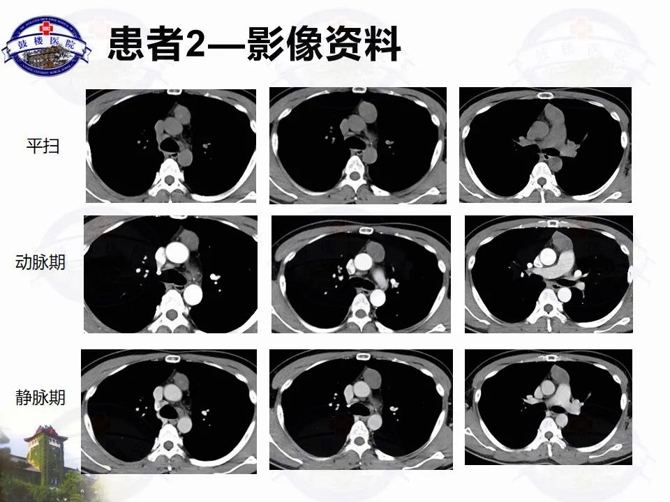 影像PPT - 【PPT】纵隔囊性病变CT诊断-4