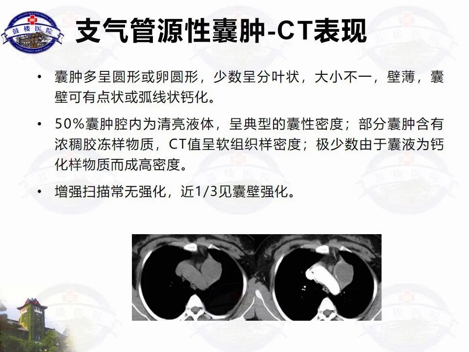 影像PPT - 【PPT】纵隔囊性病变CT诊断-15