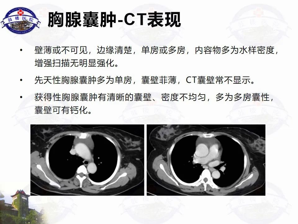 影像PPT - 【PPT】纵隔囊性病变CT诊断-19