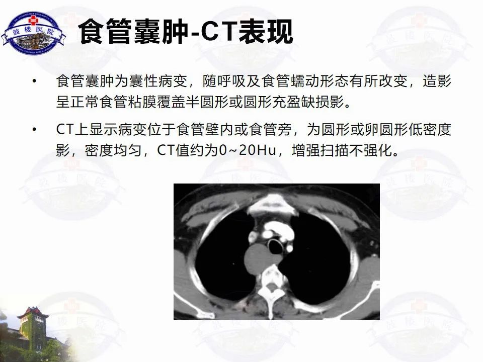 影像PPT - 【PPT】纵隔囊性病变CT诊断-21