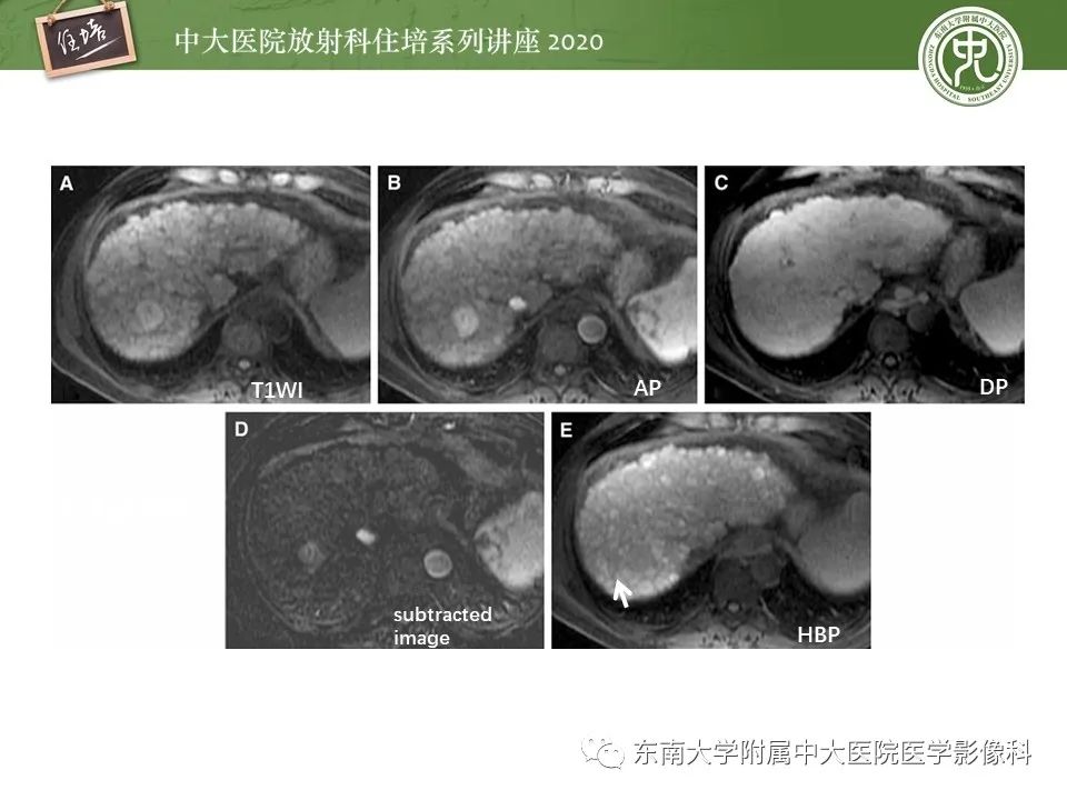 影像PPT - 【PPT】肝脏MR特异性对比剂的临床应用-20