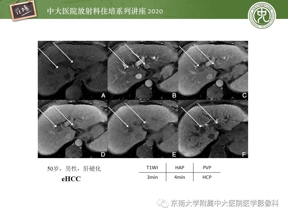 影像PPT - 【PPT】肝脏MR特异性对比剂的临床应用-22