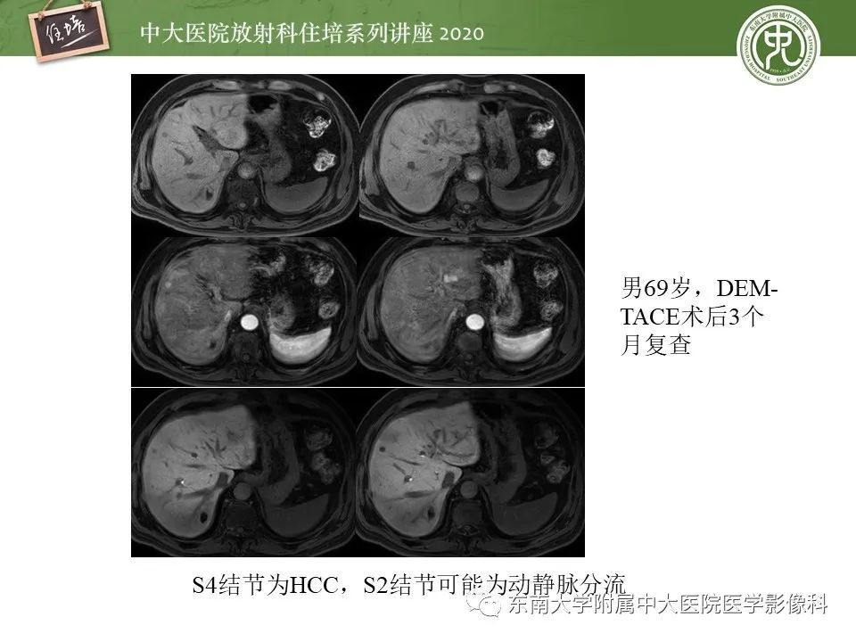 影像PPT - 【PPT】肝脏MR特异性对比剂的临床应用-30