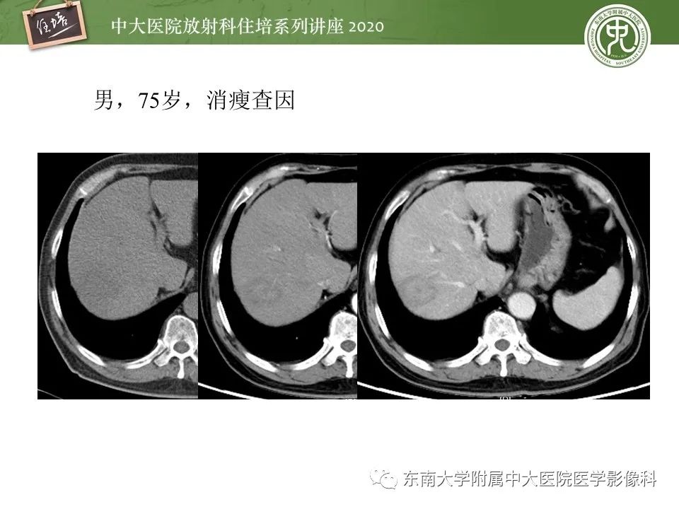 影像PPT - 【PPT】肝脏MR特异性对比剂的临床应用-37