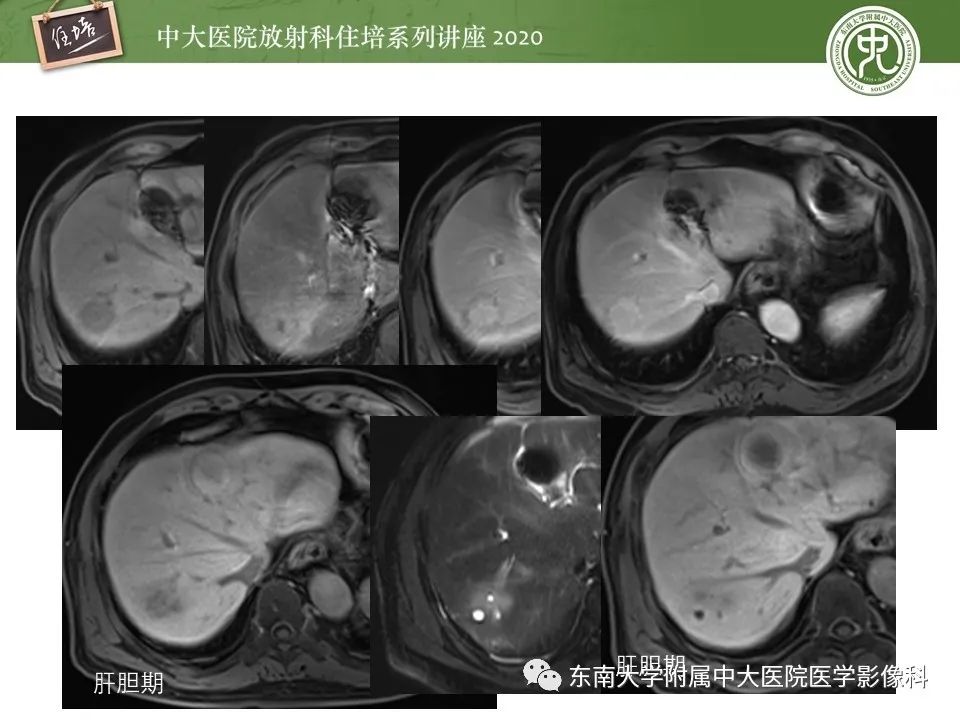 影像PPT - 【PPT】肝脏MR特异性对比剂的临床应用-38