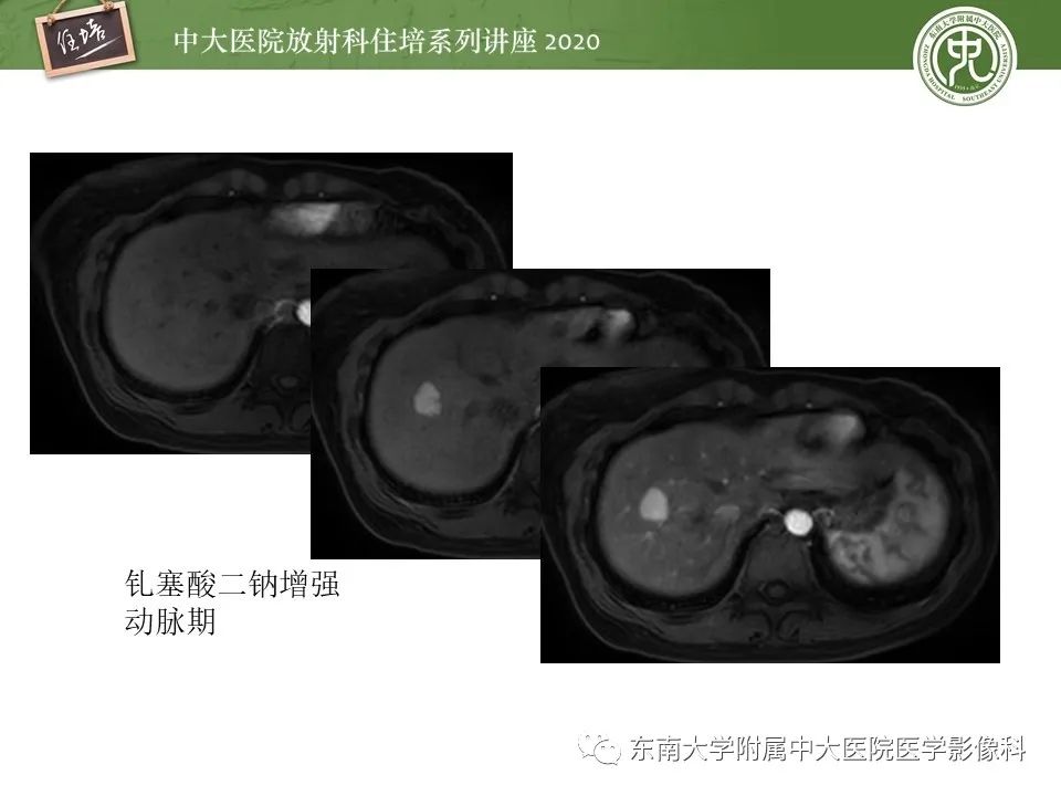 影像PPT - 【PPT】肝脏MR特异性对比剂的临床应用-42