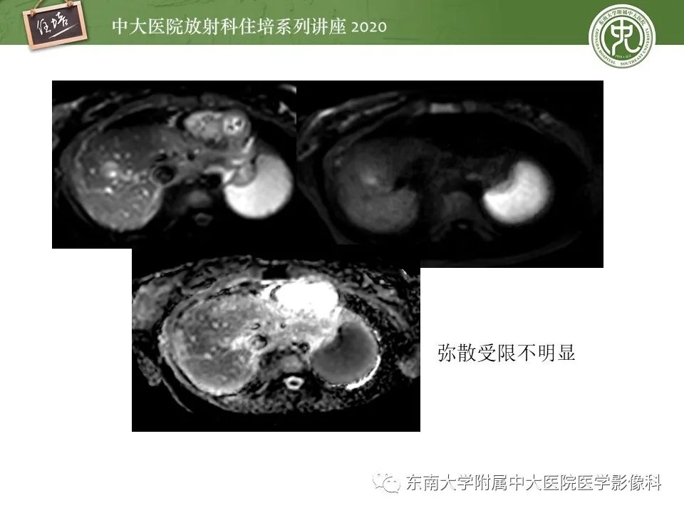 影像PPT - 【PPT】肝脏MR特异性对比剂的临床应用-43