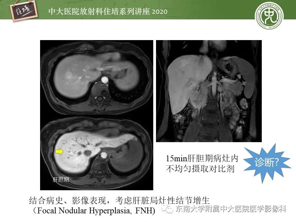 影像PPT - 【PPT】肝脏MR特异性对比剂的临床应用-44