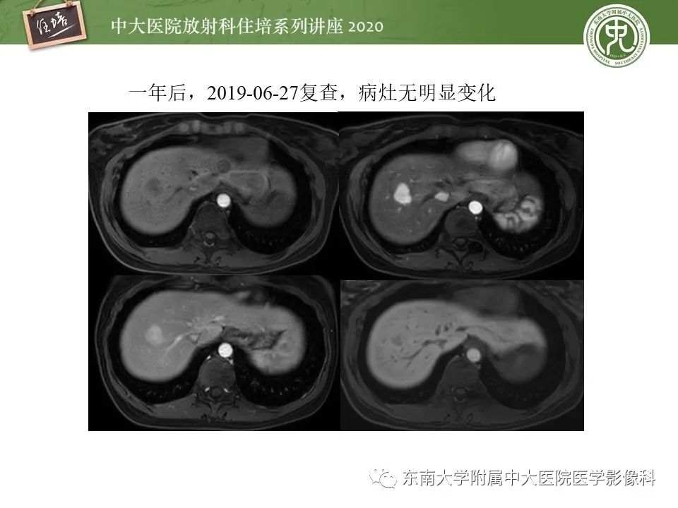 影像PPT - 【PPT】肝脏MR特异性对比剂的临床应用-45