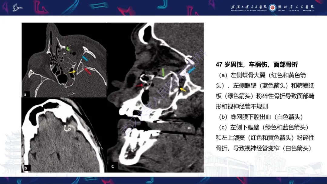 影像PPT - 【PPT】眶尖疾病影像诊断-12