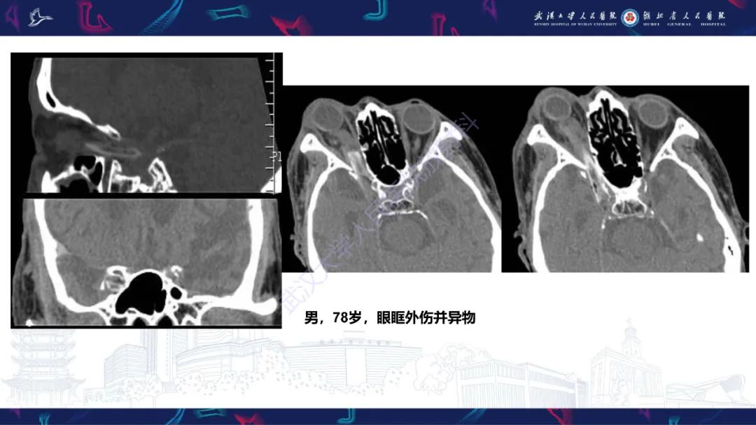 影像PPT - 【PPT】眶尖疾病影像诊断-13