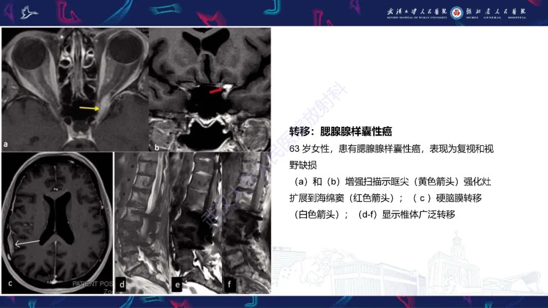 影像PPT - 【PPT】眶尖疾病影像诊断-16