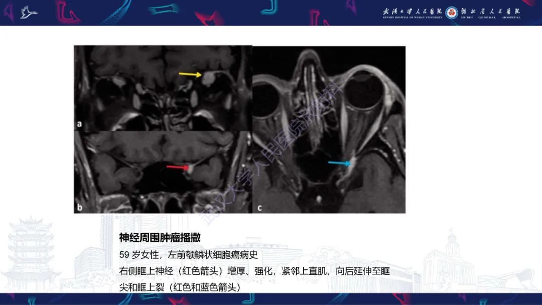 影像PPT - 【PPT】眶尖疾病影像诊断-18