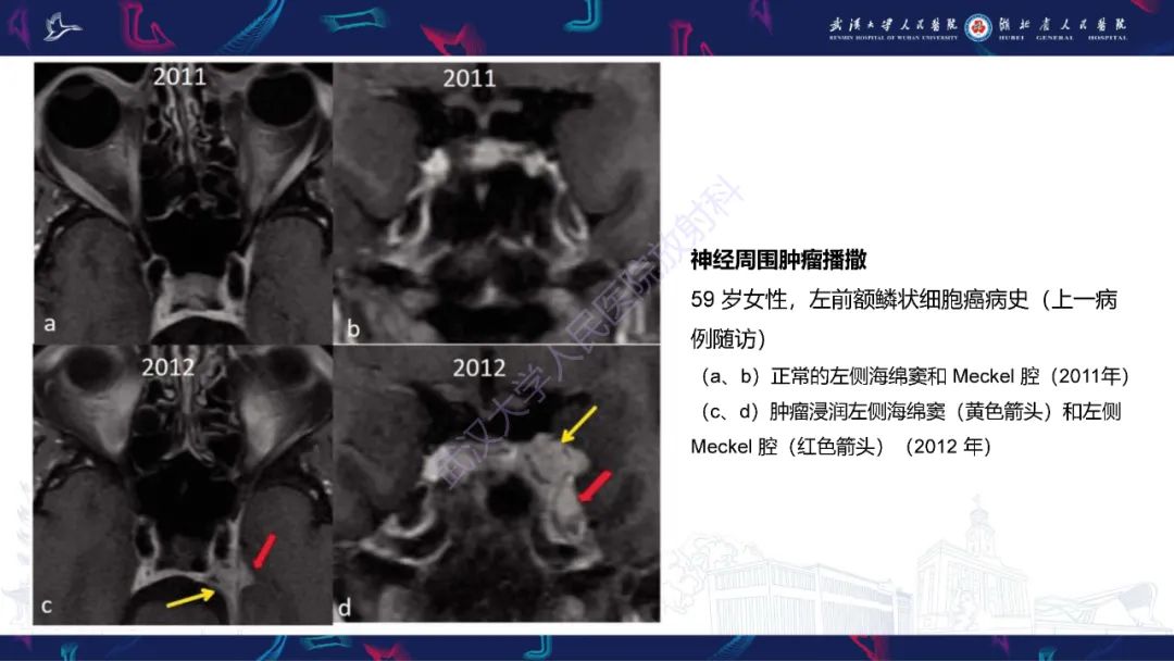 影像PPT - 【PPT】眶尖疾病影像诊断-19