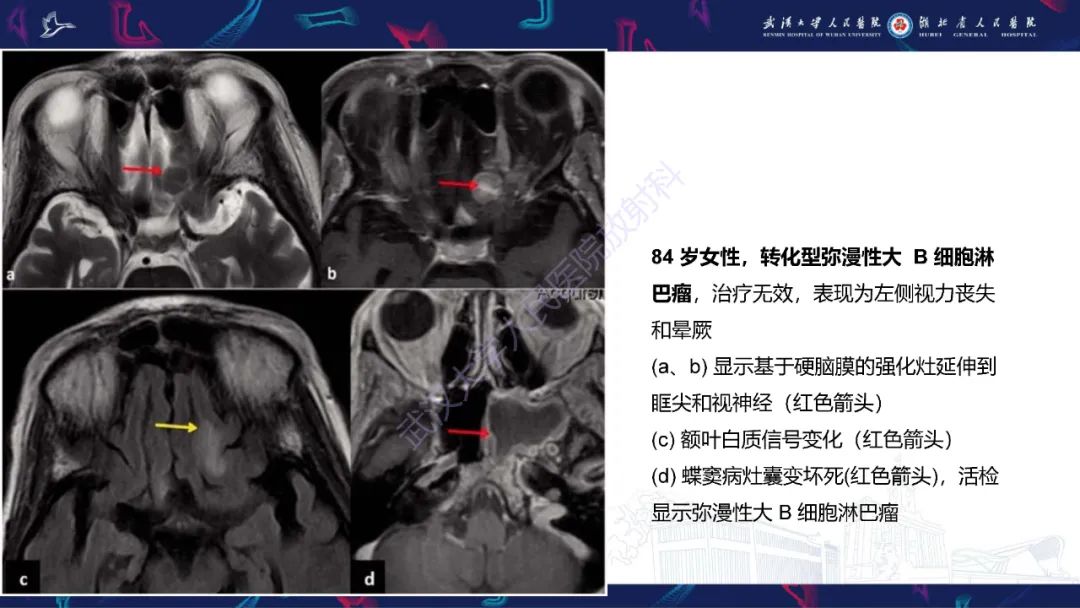 影像PPT - 【PPT】眶尖疾病影像诊断-21