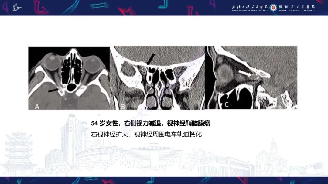 影像PPT - 【PPT】眶尖疾病影像诊断-23
