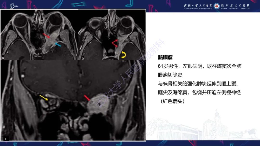 影像PPT - 【PPT】眶尖疾病影像诊断-24
