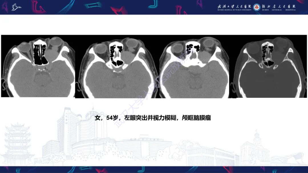 影像PPT - 【PPT】眶尖疾病影像诊断-25