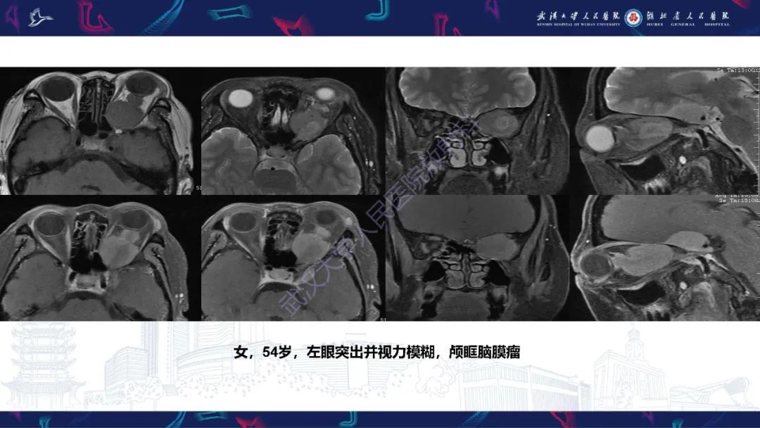 影像PPT - 【PPT】眶尖疾病影像诊断-26